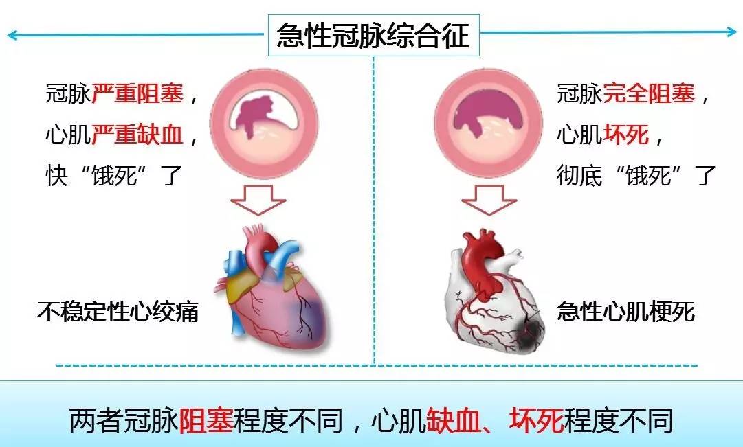 市立晨課丨急性冠脈綜合徵患者警惕再發風險