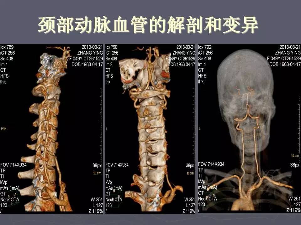 颈横血管解剖图CT图片