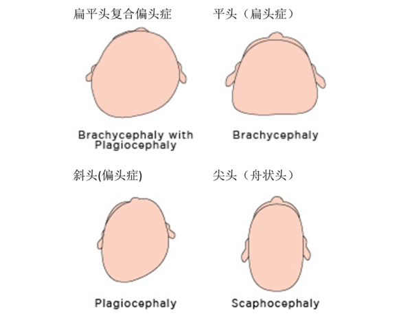 上一代睡扁头的风俗导致婴儿两侧太阳穴逐渐突出来,后脑勺看上去比