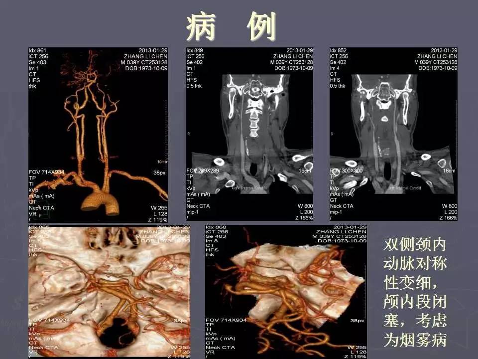 头颈血管解剖和CTA图片