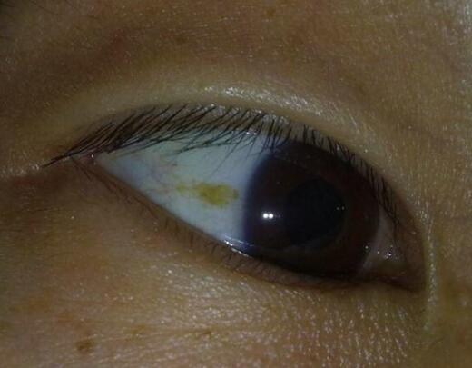 1,眼睛:人的眼睛代表了人体五脏六腑的机能状况,如果你眼珠发黄和皮肤