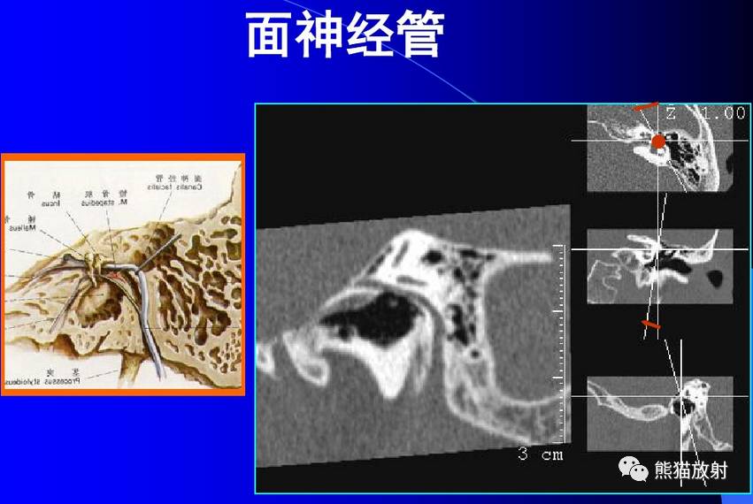 面神经管 断层图片