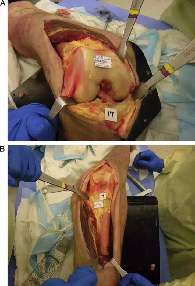 股骨远端髁间骨折手术入路该如何选择