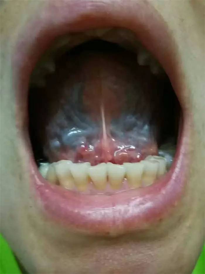 舌下出血点图片图片