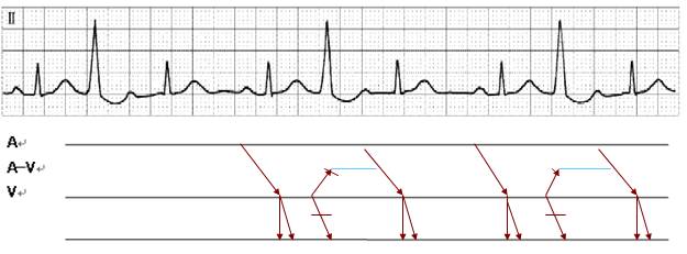 你还在为看不懂心电图而烦恼吗?