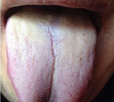 不正常的舌头图片图片