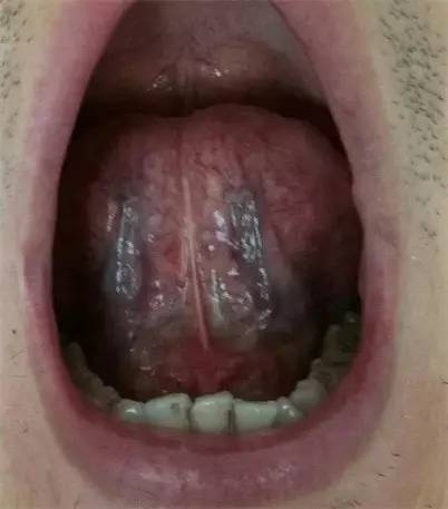 舌下放血骗局图片