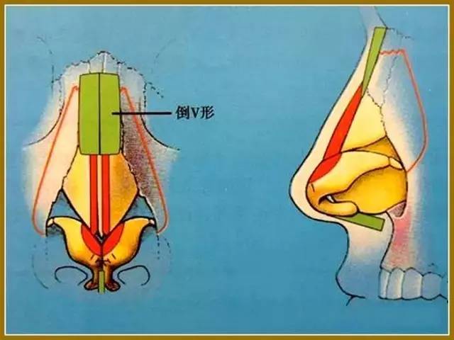 鼻中隔手术图解图片