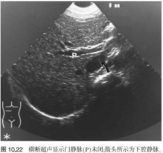 多普勒超声 该检查可显示门静脉和肝动脉的解剖结构.