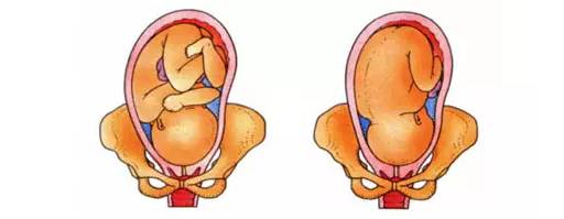 周後胎兒在母體子宮內出現非枕前位以及其他異常胎位,包括枕後位,臀位
