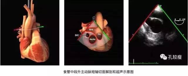 超声心动图怎么做图片