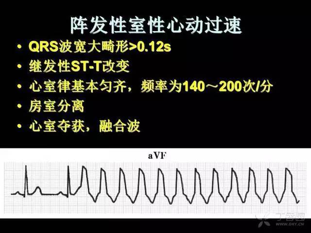 精彩幻灯:阵发性心动过速