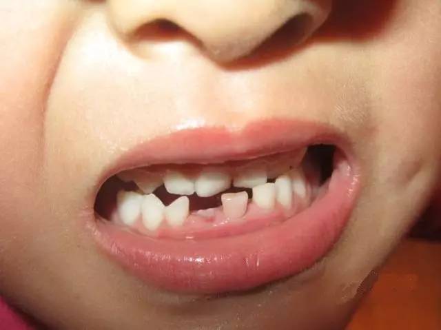 婴儿牙齿变黄并不罕见,忽视这三点,小心宝宝牙齿越来越黄!