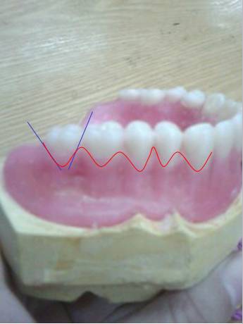 全口義齒製作中最易出的問題下排牙與調he