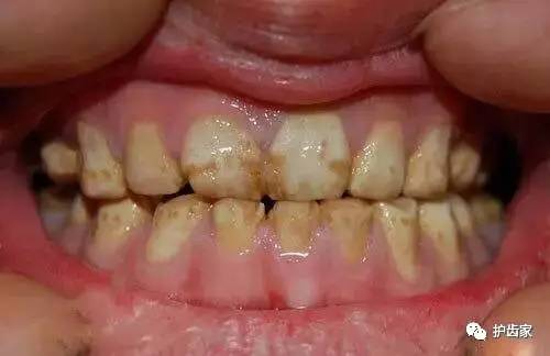 含氟牙膏会导致氟斑牙可能是你用错了方法