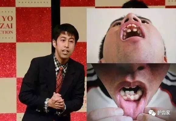为什么日本人都是龅牙揭秘日本人牙齿里的大秘密