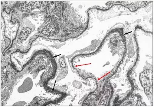 圖 21 紅色箭頭:腎小球基底膜節段性變薄;黑色箭頭:腎小球基底膜節段