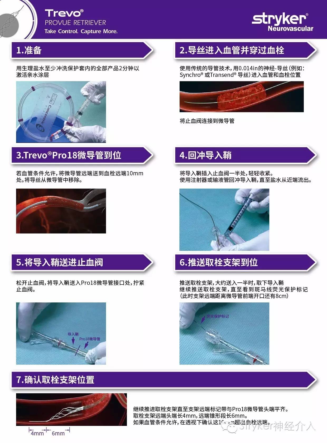 操作trevoprovue取栓支架系统操作步骤详解