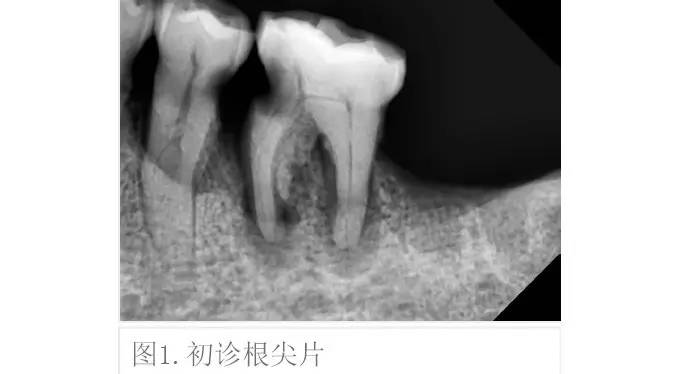 牙齿颈嵴图片